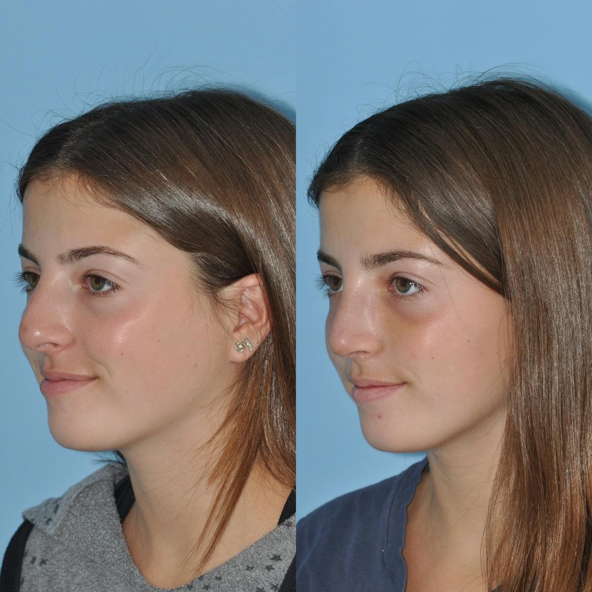 Rhinoplasty Before & After Gallery - Patient 414599 - Image 7