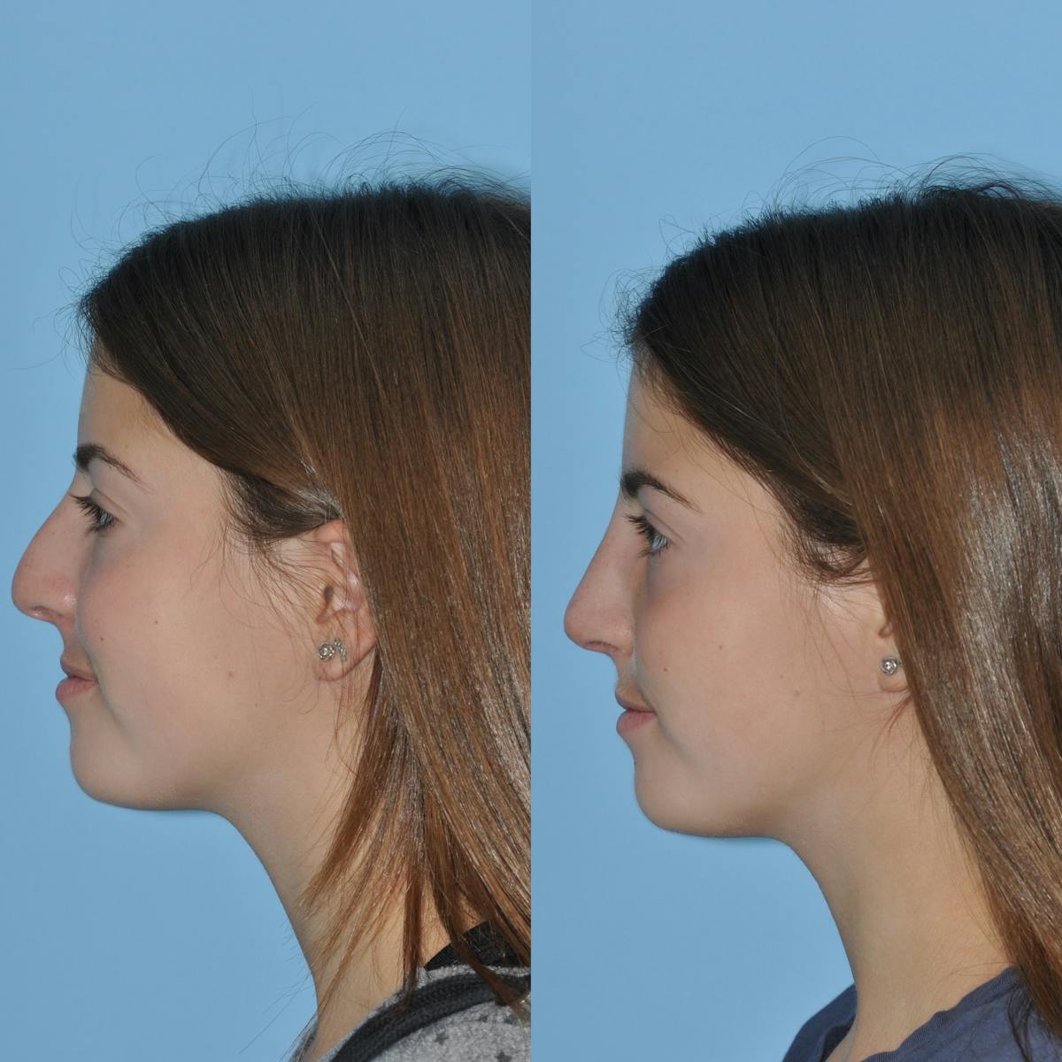Rhinoplasty Before & After Gallery - Patient 414599 - Image 8