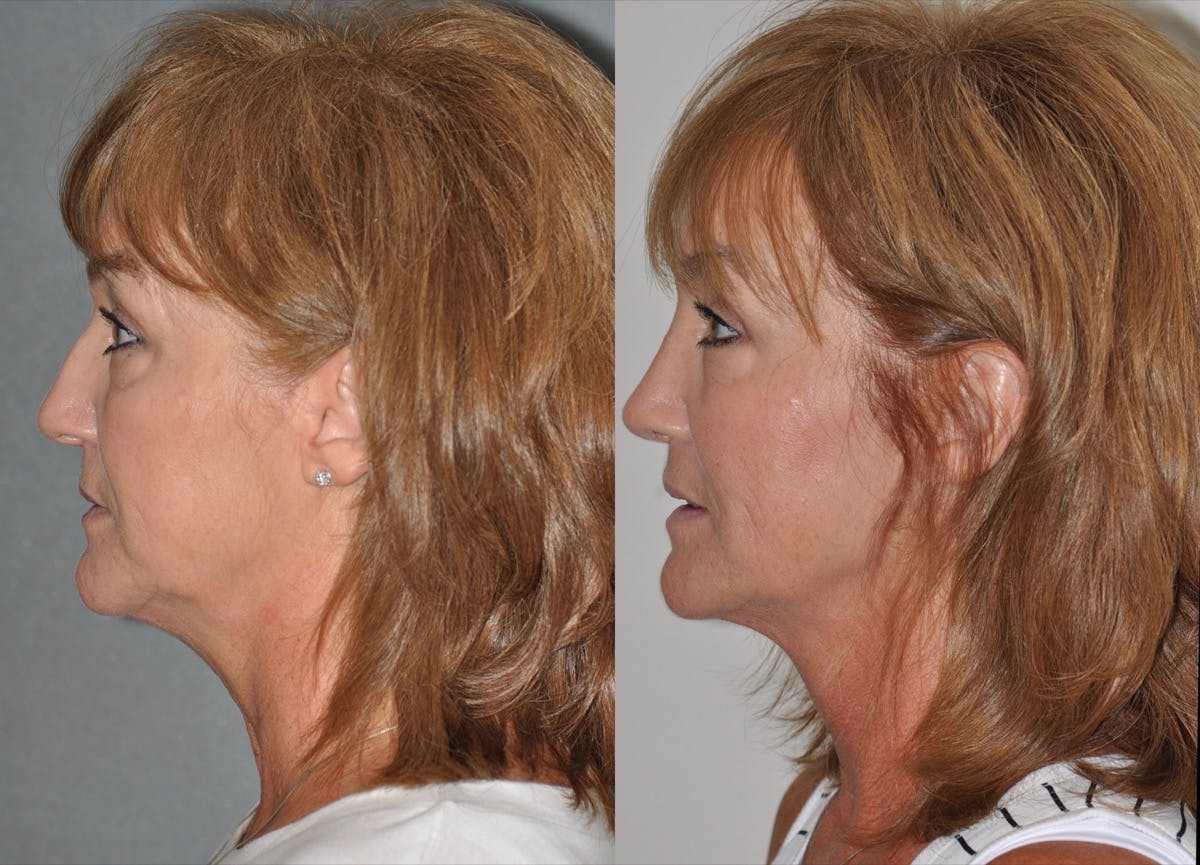 Rhinoplasty Before & After Gallery - Patient 850581 - Image 1