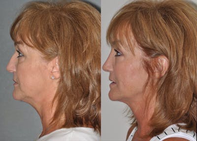 Rhinoplasty Before & After Gallery - Patient 850581 - Image 1