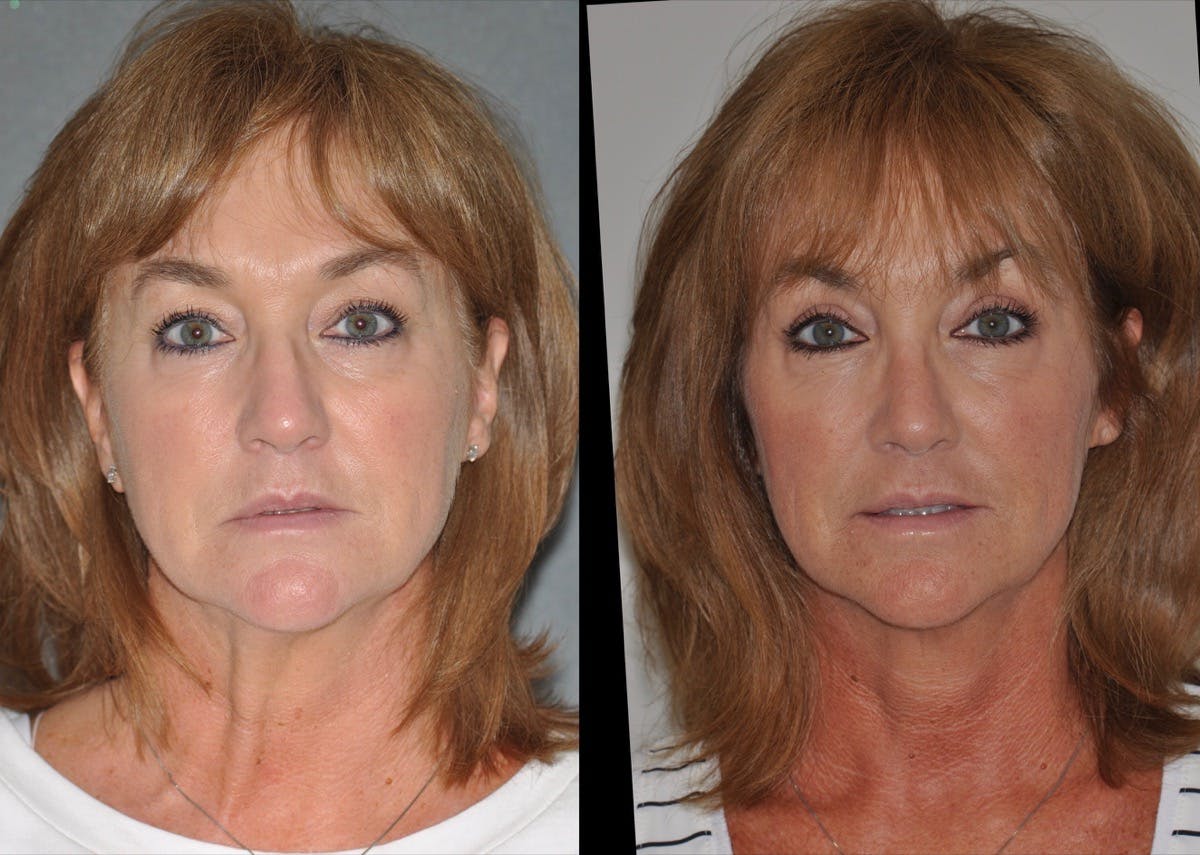 Rhinoplasty Before & After Gallery - Patient 850581 - Image 2