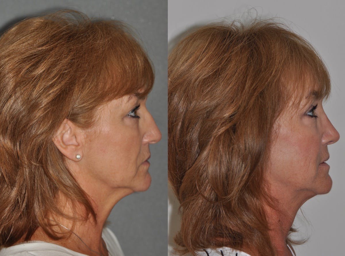 Rhinoplasty Before & After Gallery - Patient 850581 - Image 3