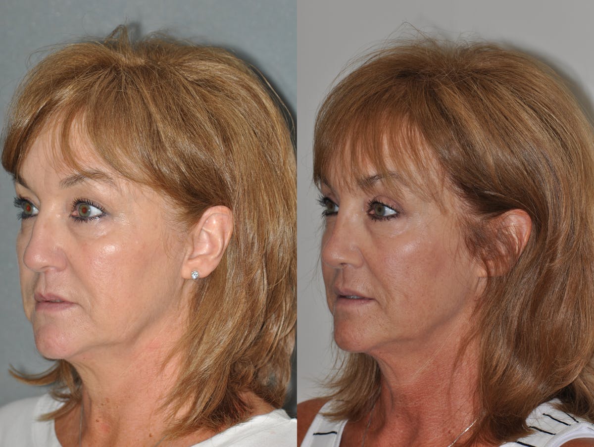 Rhinoplasty Before & After Gallery - Patient 850581 - Image 4
