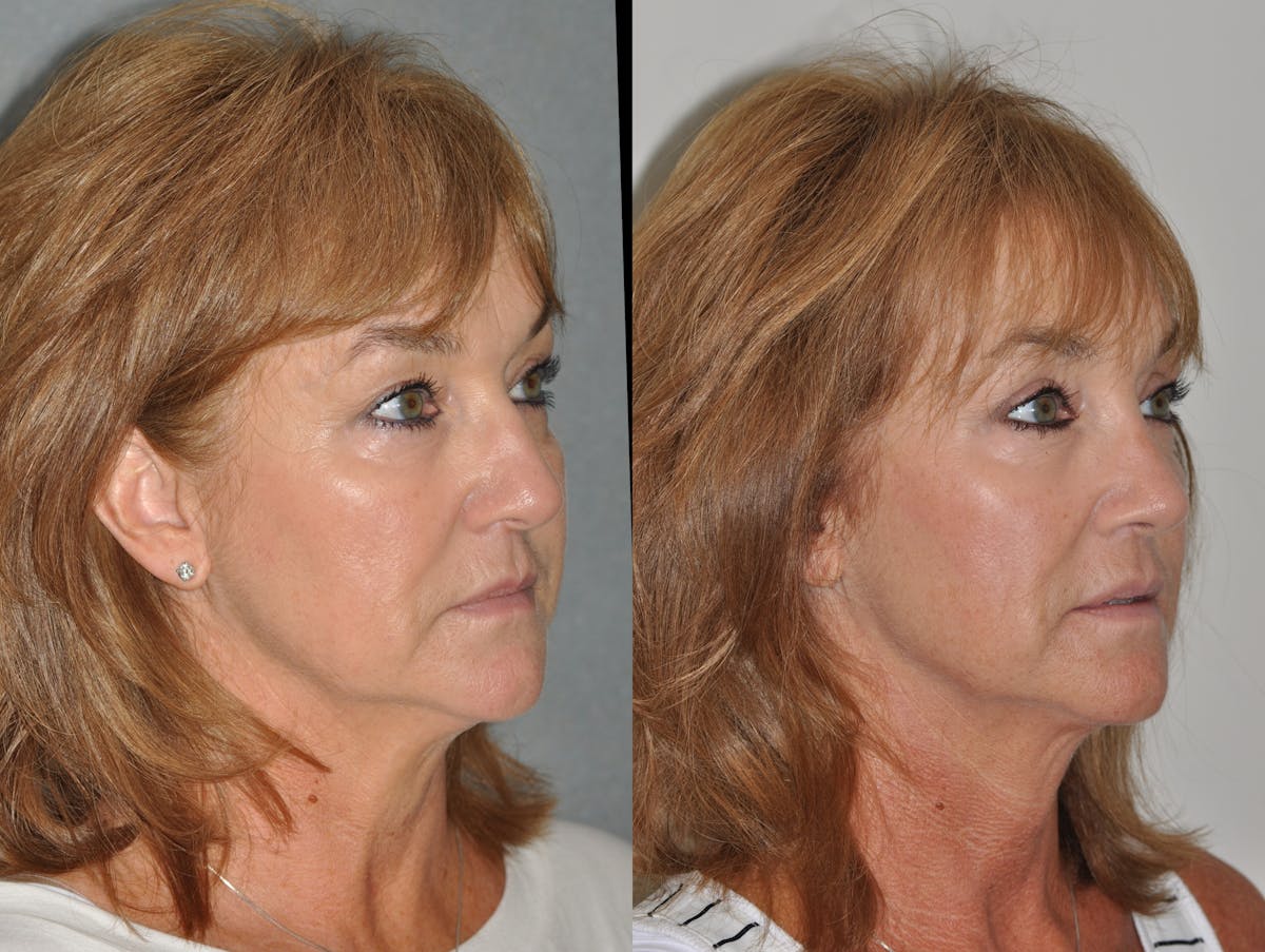 Rhinoplasty Before & After Gallery - Patient 850581 - Image 5