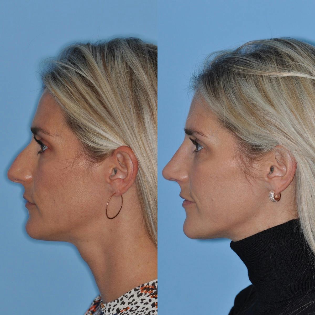 Rhinoplasty Before & After Gallery - Patient 232037 - Image 1
