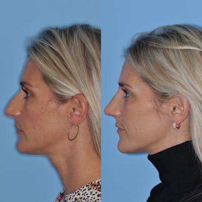 Rhinoplasty Before & After Gallery - Patient 232037 - Image 1