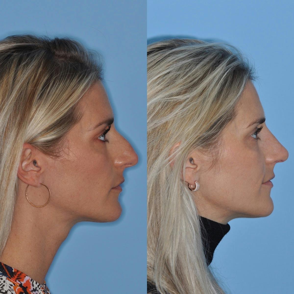 Rhinoplasty Before & After Gallery - Patient 232037 - Image 2