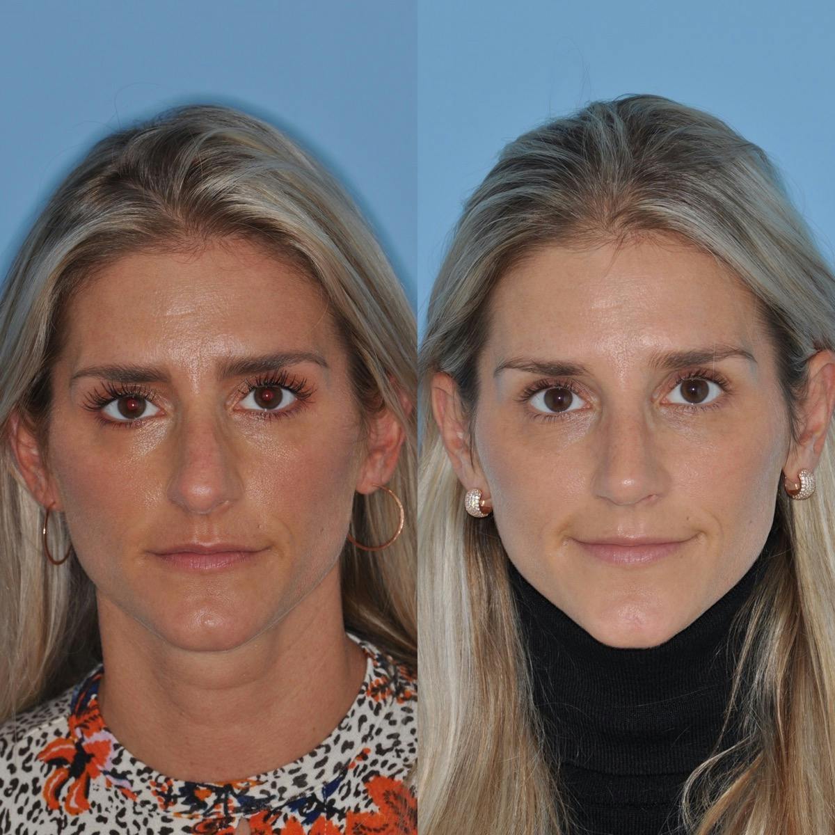 Rhinoplasty Before & After Gallery - Patient 232037 - Image 3