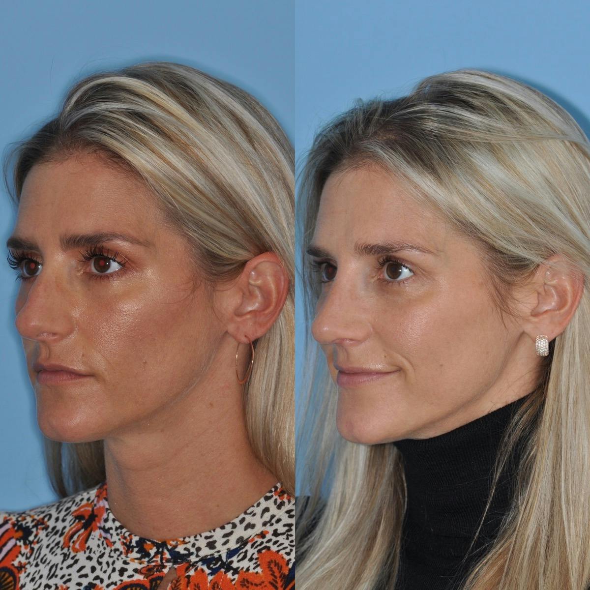Rhinoplasty Before & After Gallery - Patient 232037 - Image 4