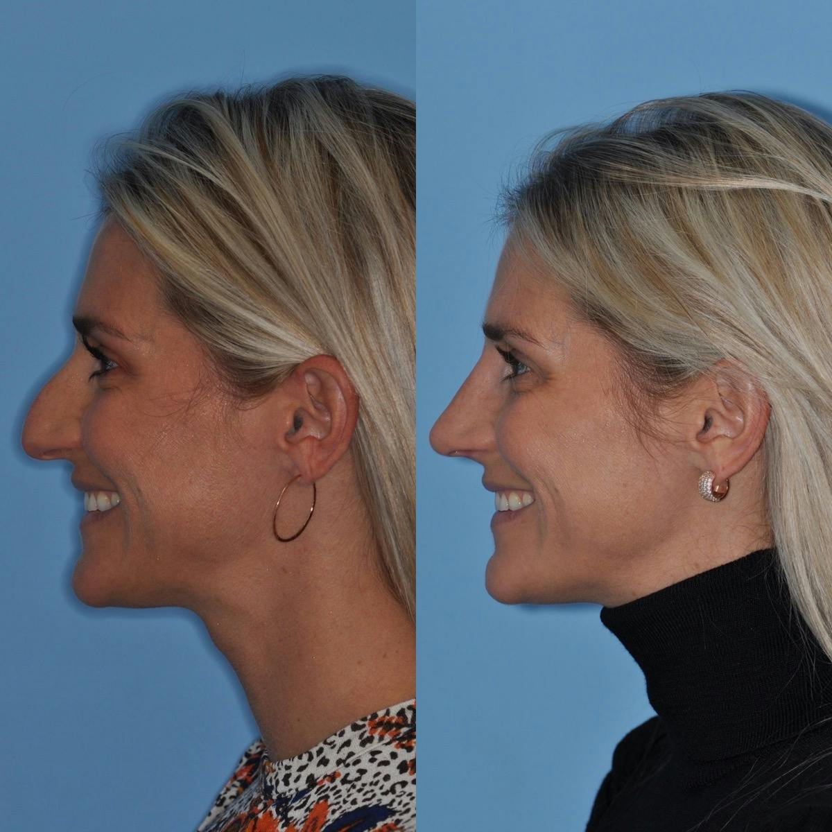 Rhinoplasty Before & After Gallery - Patient 232037 - Image 5
