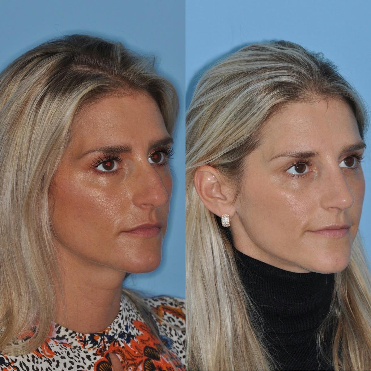 Rhinoplasty Before & After Gallery - Patient 232037 - Image 7