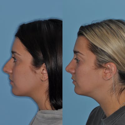 Rhinoplasty Before & After Gallery - Patient 254255 - Image 1