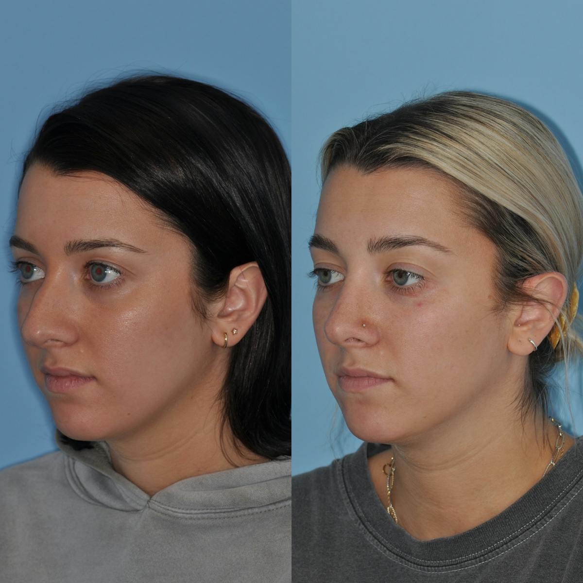 Rhinoplasty Before & After Gallery - Patient 254255 - Image 3