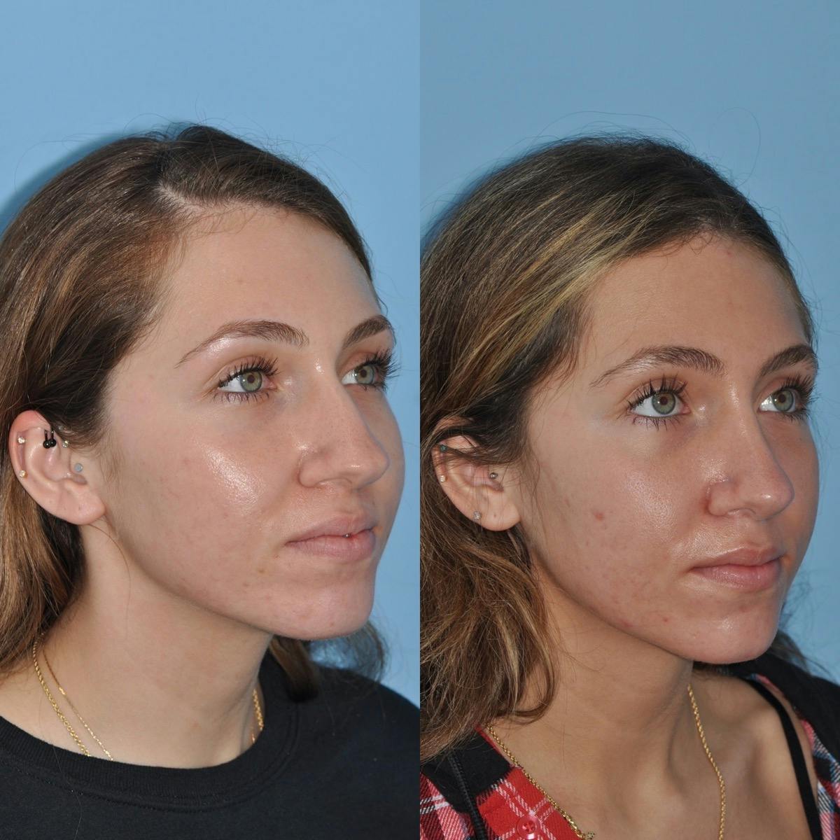 Rhinoplasty Before & After Gallery - Patient 354394 - Image 3