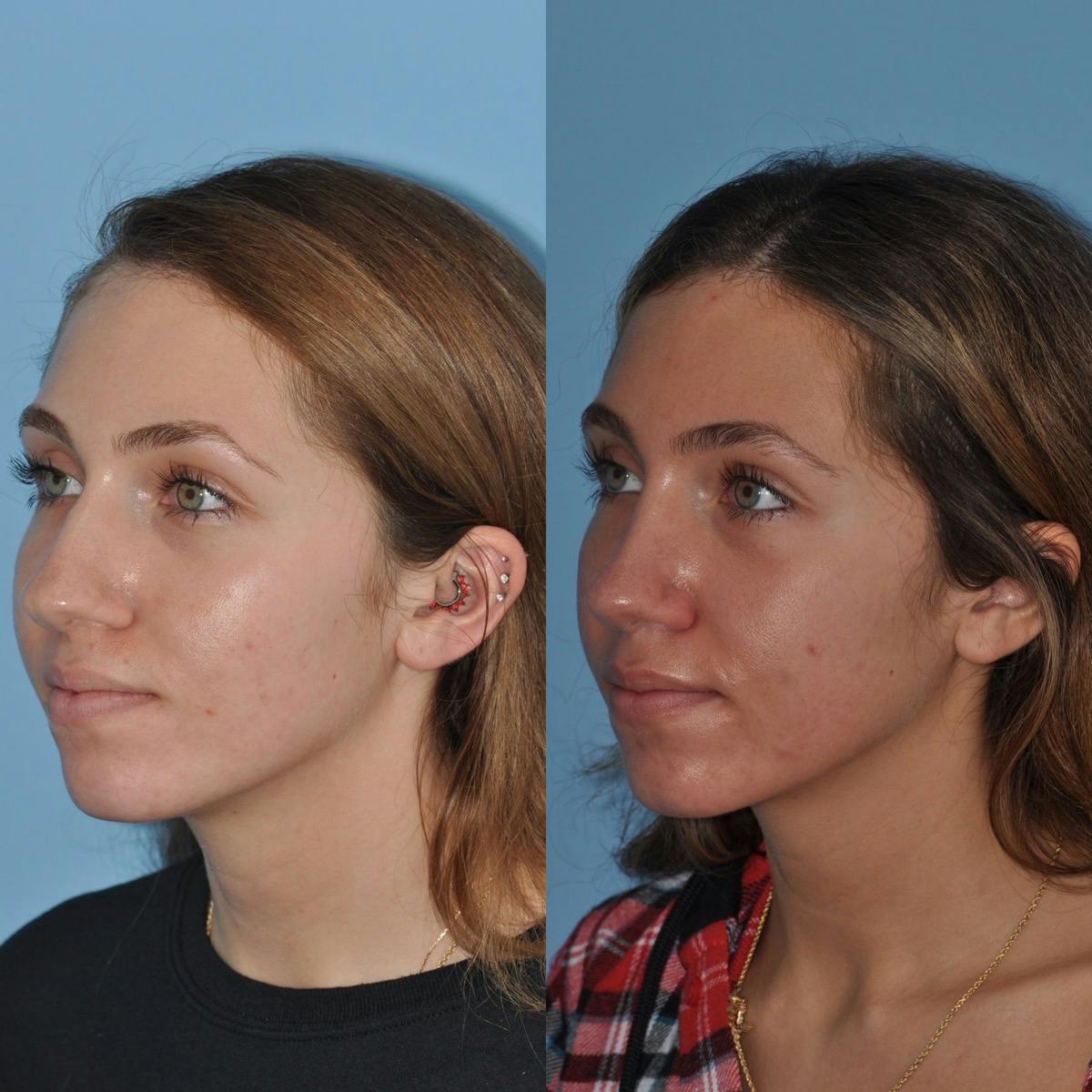 Rhinoplasty Before & After Gallery - Patient 354394 - Image 4