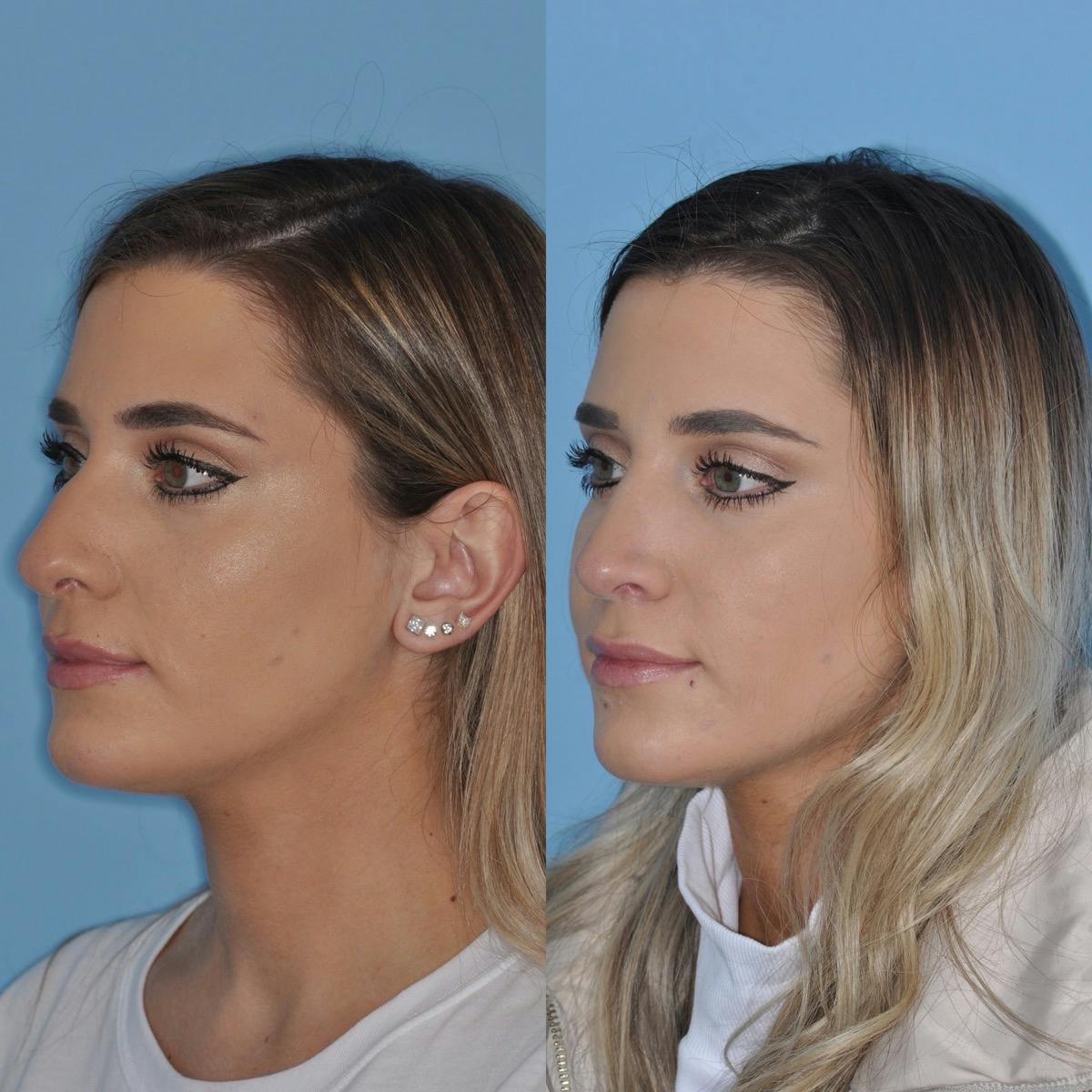 Rhinoplasty Before & After Gallery - Patient 424620 - Image 1
