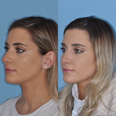 Rhinoplasty Before & After Gallery - Patient 424620 - Image 1