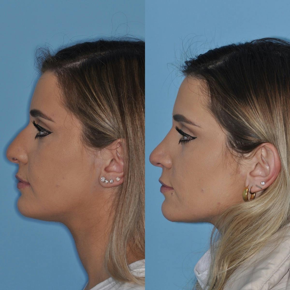 Rhinoplasty Before & After Gallery - Patient 424620 - Image 4