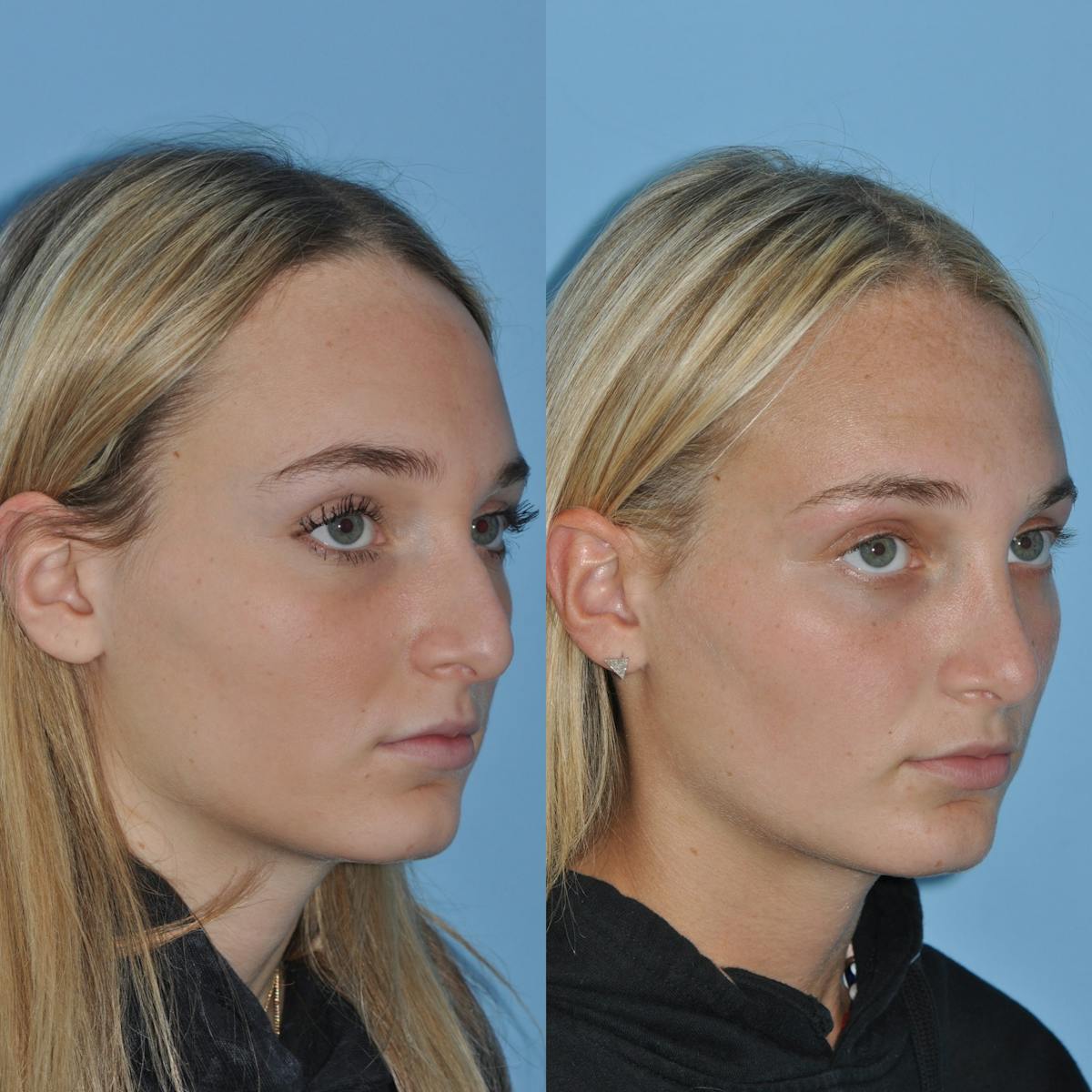 Rhinoplasty Before & After Gallery - Patient 407536 - Image 2