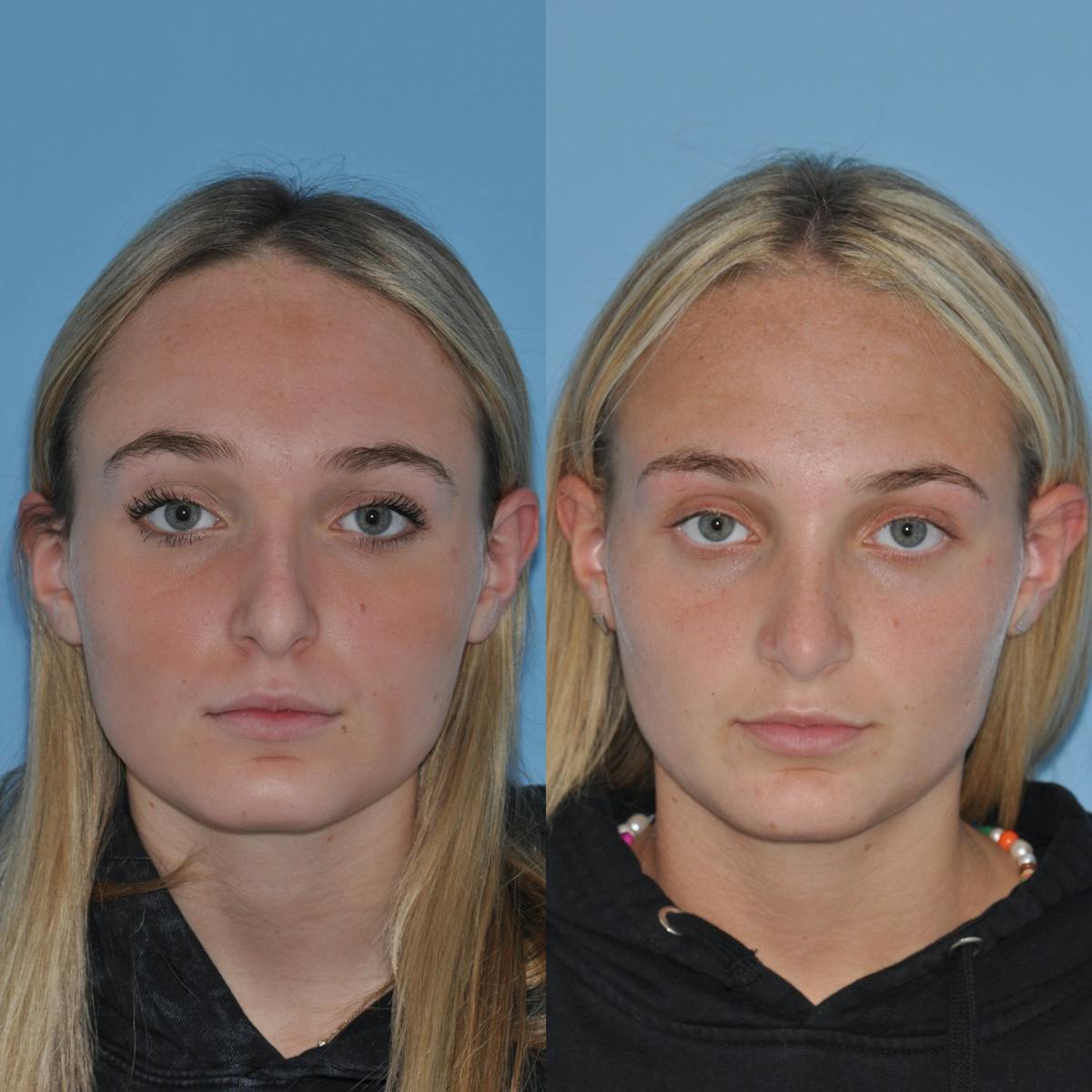 Rhinoplasty Before & After Gallery - Patient 407536 - Image 3