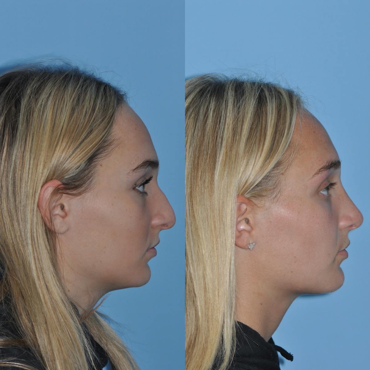 Rhinoplasty Before & After Gallery - Patient 407536 - Image 4