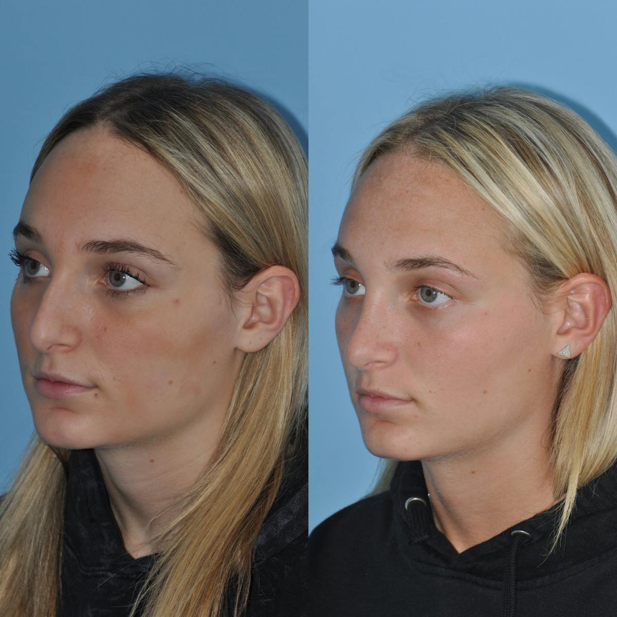Rhinoplasty Before & After Gallery - Patient 407536 - Image 5