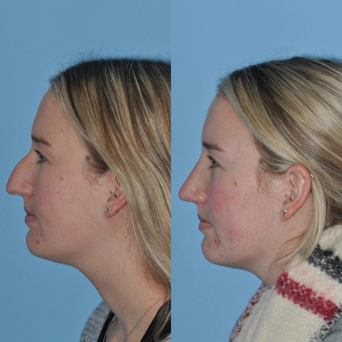 Rhinoplasty Before & After Gallery - Patient 204971 - Image 2