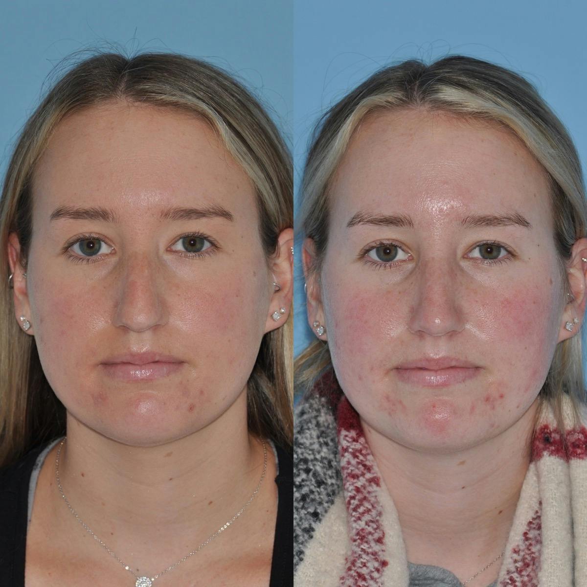 Rhinoplasty Before & After Gallery - Patient 204971 - Image 4