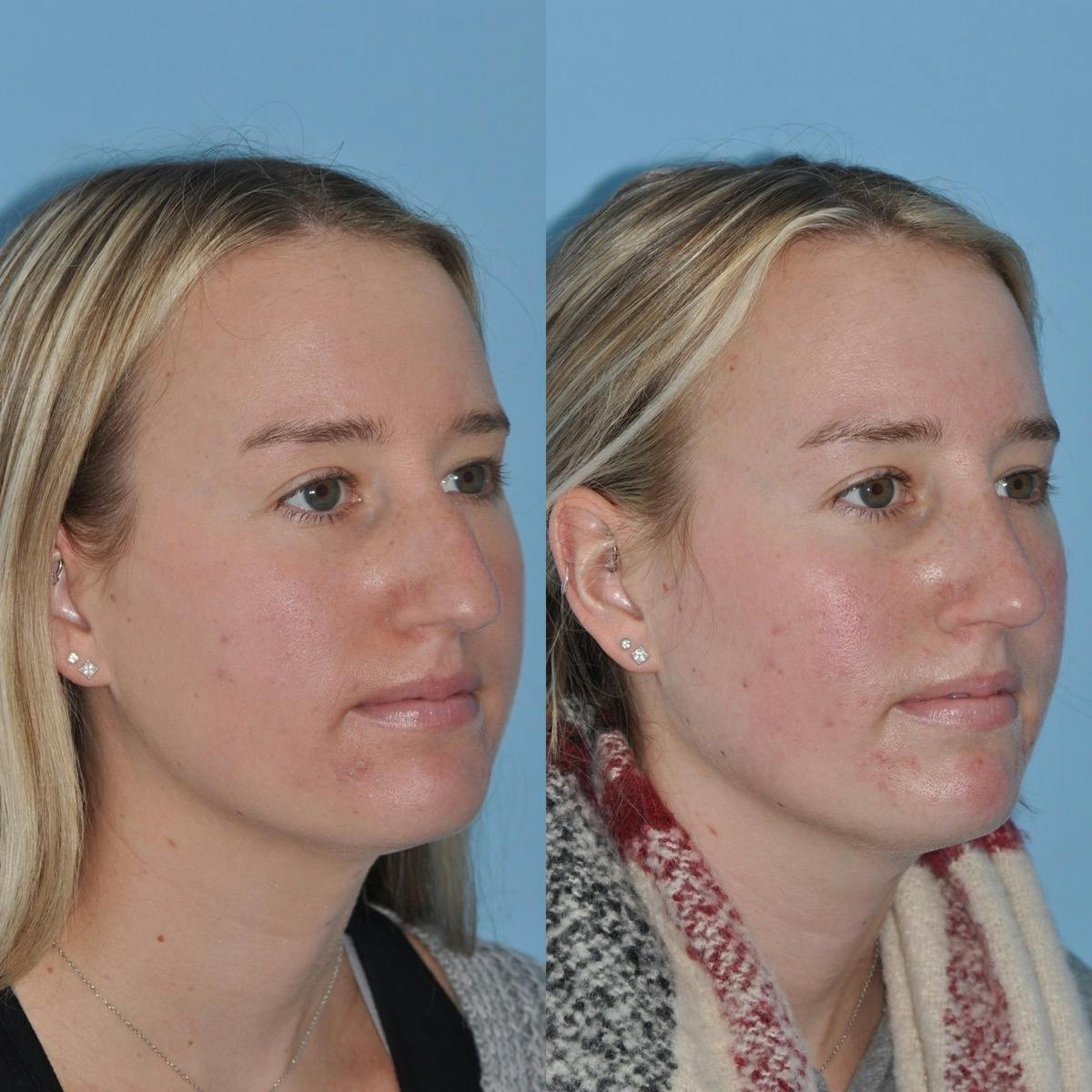 Rhinoplasty Before & After Gallery - Patient 204971 - Image 5