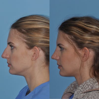Rhinoplasty Before & After Gallery - Patient 223569 - Image 1