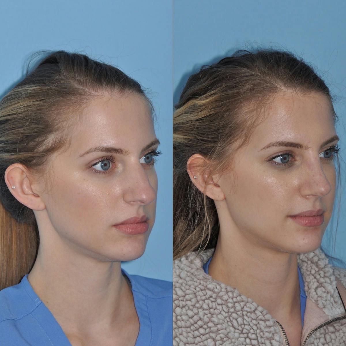 Rhinoplasty Before & After Gallery - Patient 223569 - Image 4