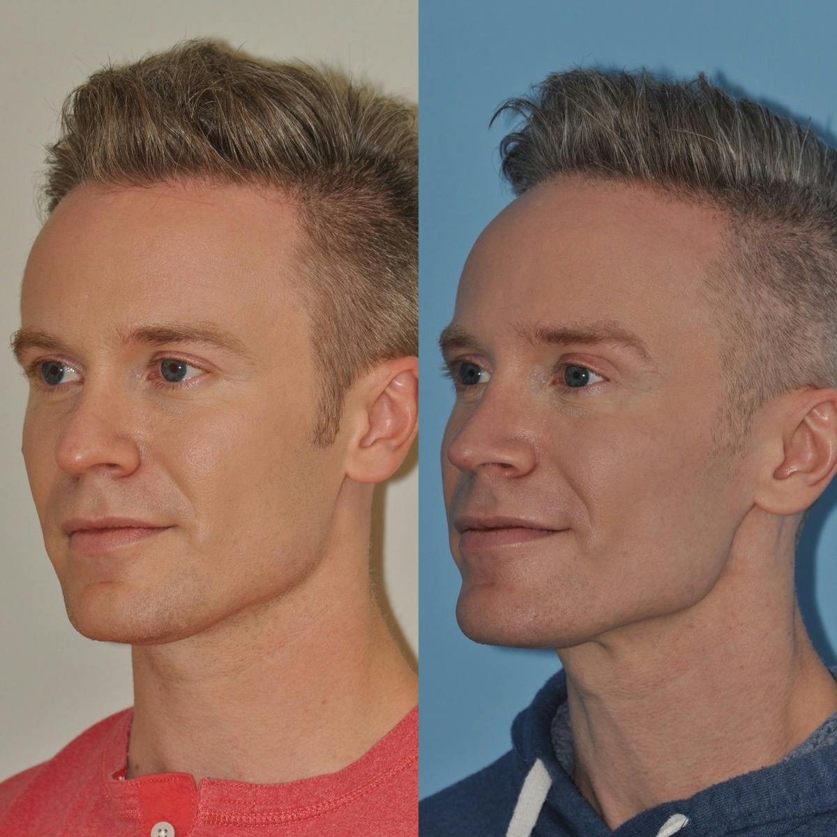 Rhinoplasty Before & After Gallery - Patient 424175 - Image 2