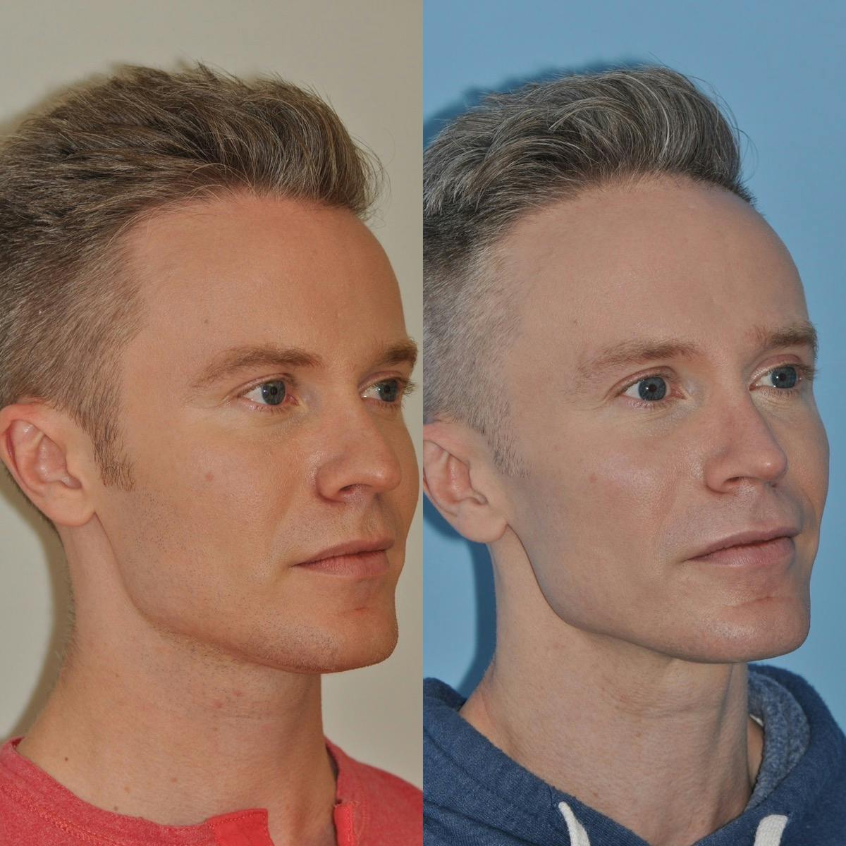 Rhinoplasty Before & After Gallery - Patient 424175 - Image 3