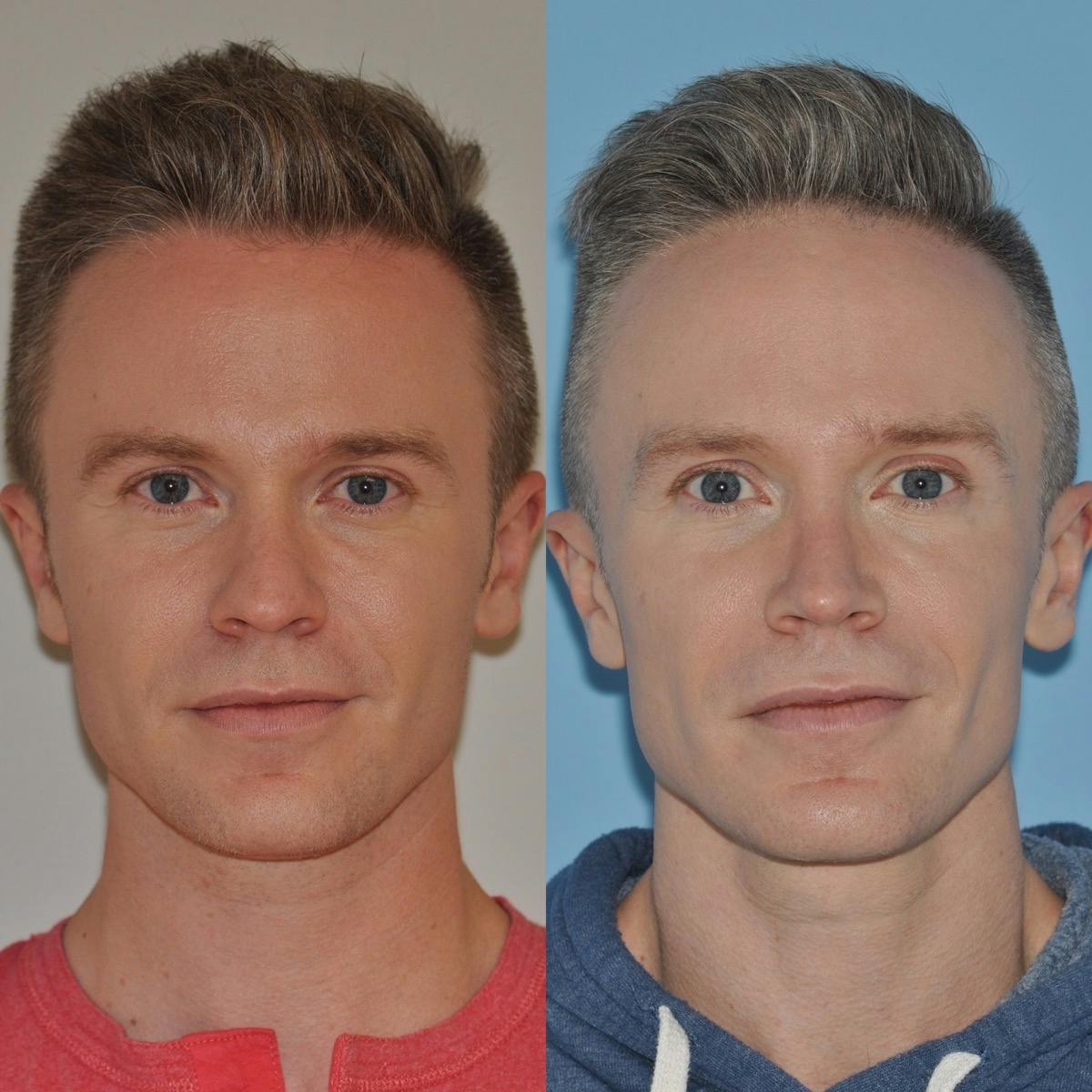 Rhinoplasty Before & After Gallery - Patient 424175 - Image 5
