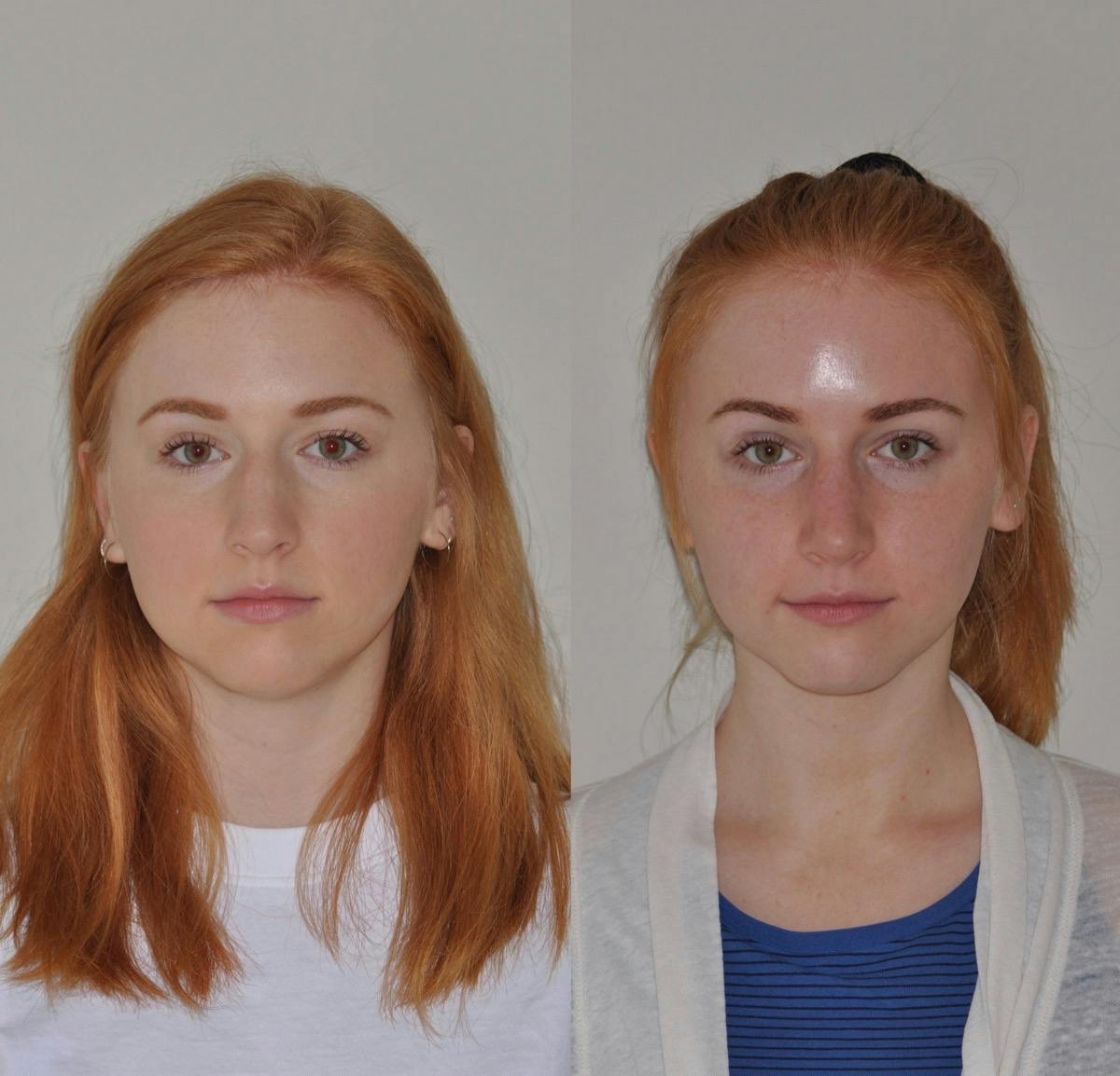Rhinoplasty Before & After Gallery - Patient 166758 - Image 2