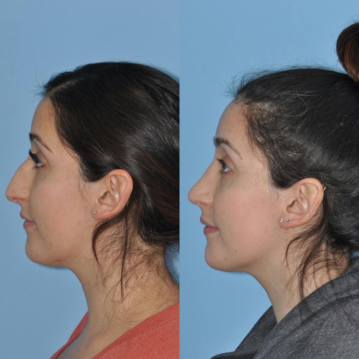 Rhinoplasty Before & After Gallery - Patient 100368 - Image 1