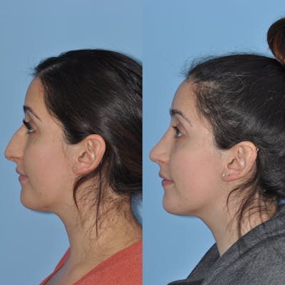 Rhinoplasty Before & After Gallery - Patient 100368 - Image 1