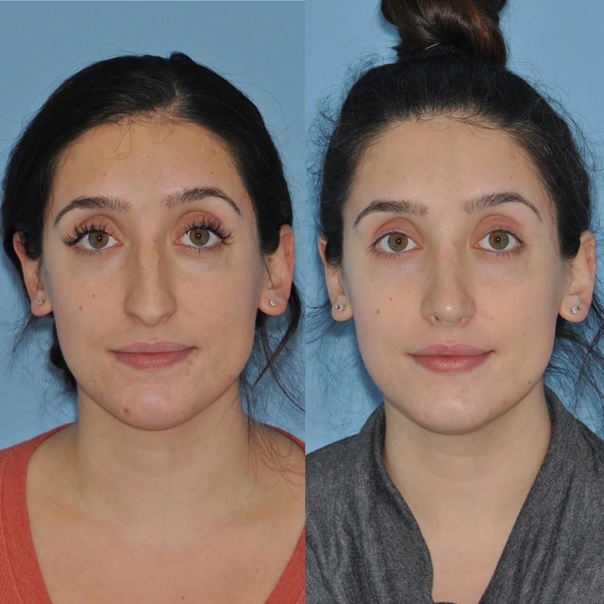 Rhinoplasty Before & After Gallery - Patient 100368 - Image 2
