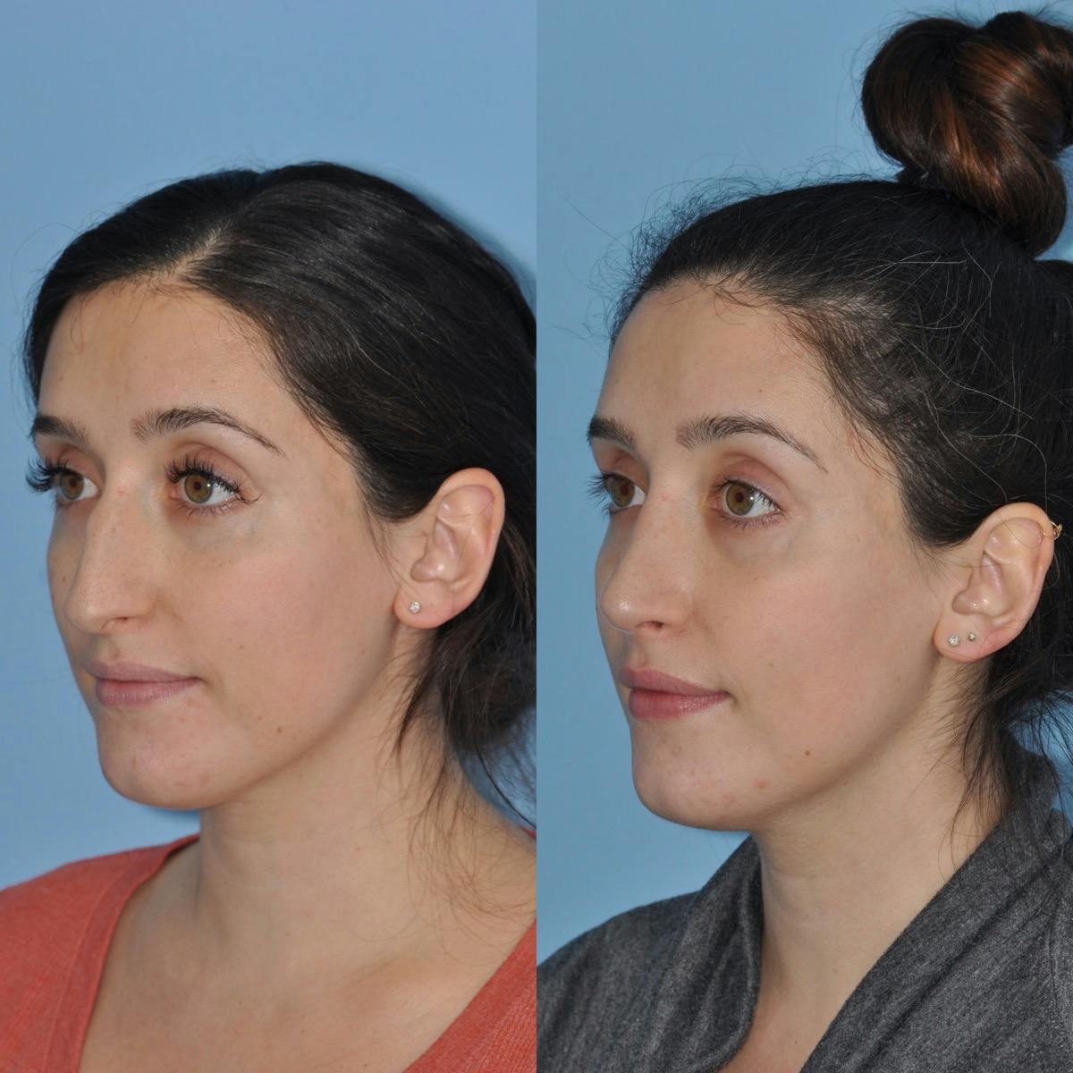 Rhinoplasty Before & After Gallery - Patient 100368 - Image 3