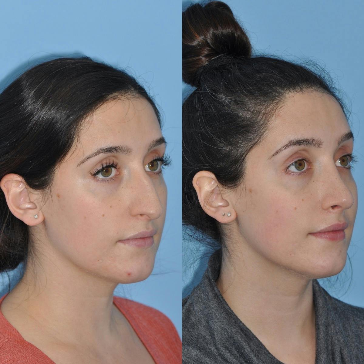 Rhinoplasty Before & After Gallery - Patient 100368 - Image 5