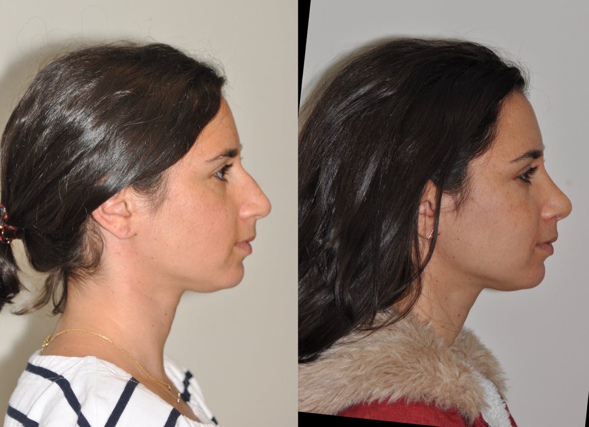 Rhinoplasty Before & After Gallery - Patient 303481 - Image 2