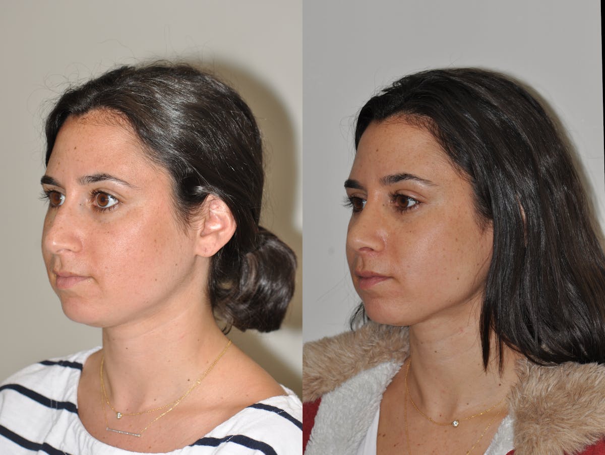 Rhinoplasty Before & After Gallery - Patient 303481 - Image 3