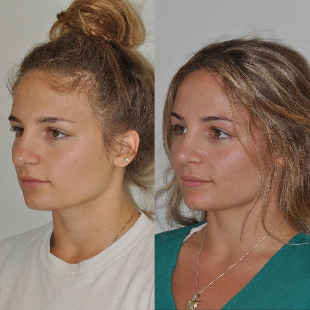 Rhinoplasty Before & After Gallery - Patient 357351 - Image 2