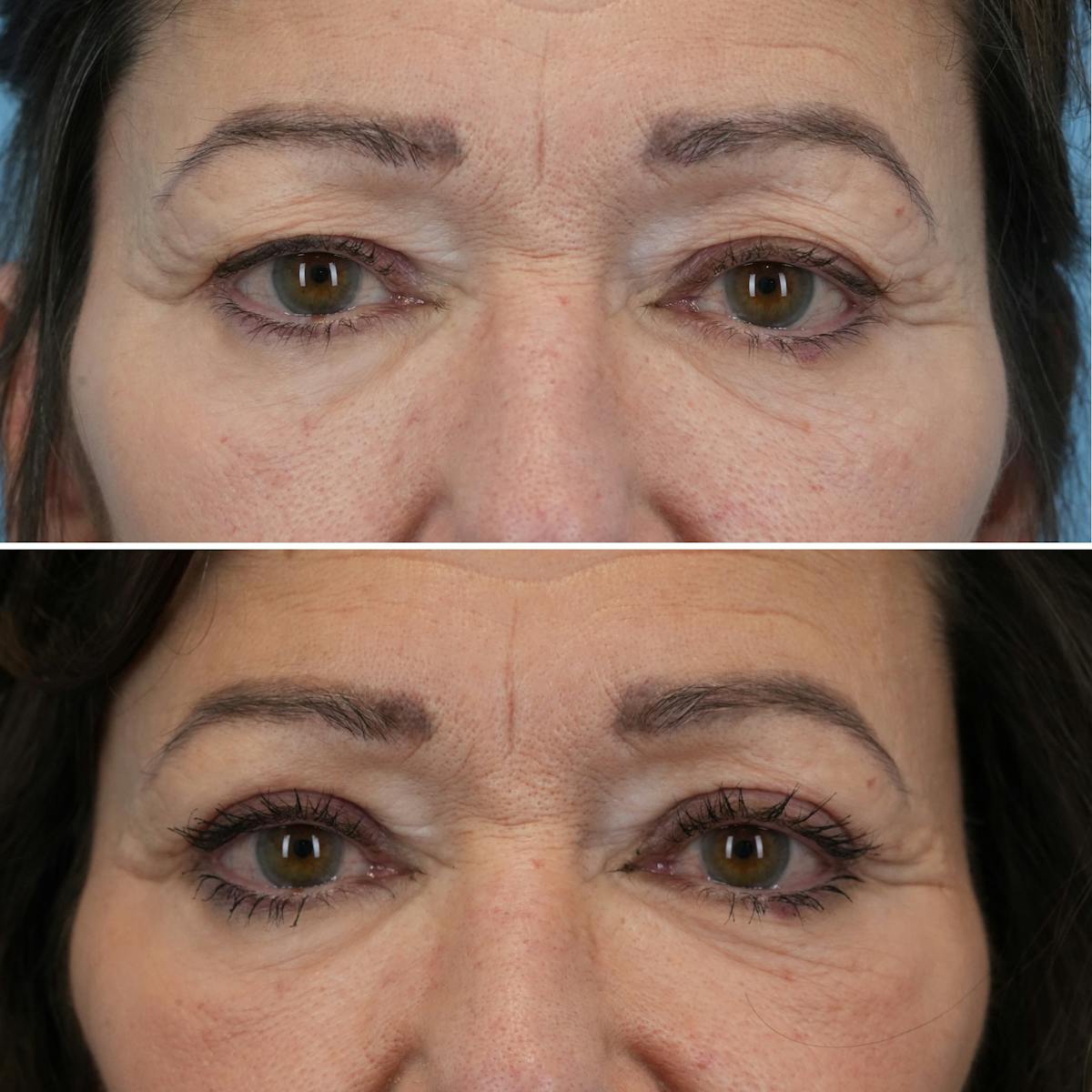Blepharoplasty Before & After Gallery - Patient 291424 - Image 1