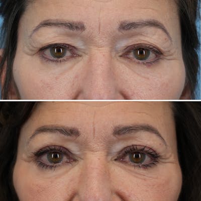 Blepharoplasty Before & After Gallery - Patient 291424 - Image 1