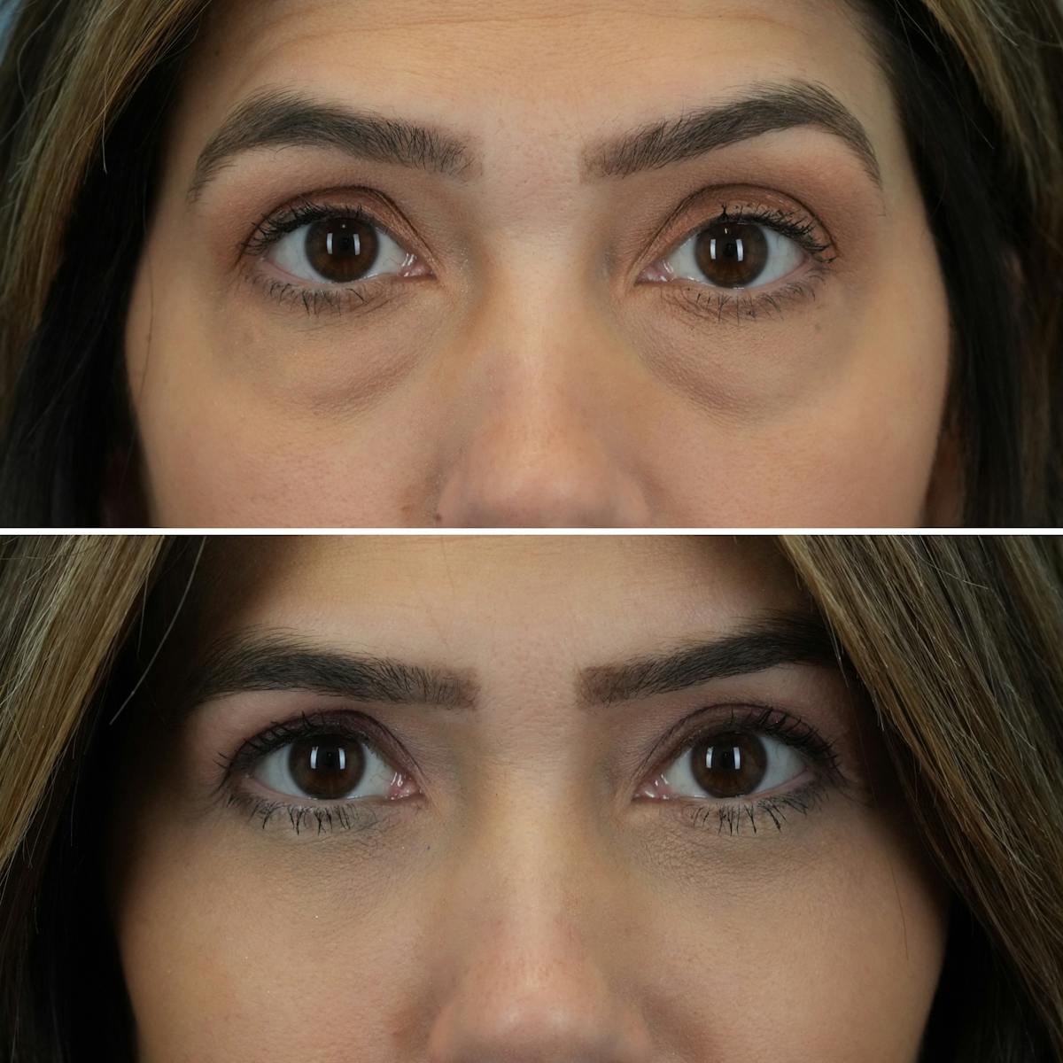 Blepharoplasty Before & After Gallery - Patient 841823 - Image 1