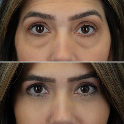 Blepharoplasty Before & After Gallery - Patient 841823 - Image 1