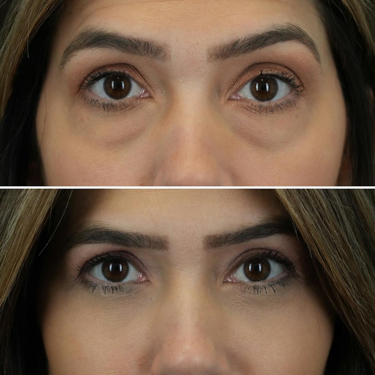 Blepharoplasty Before & After Gallery - Patient 841823 - Image 2