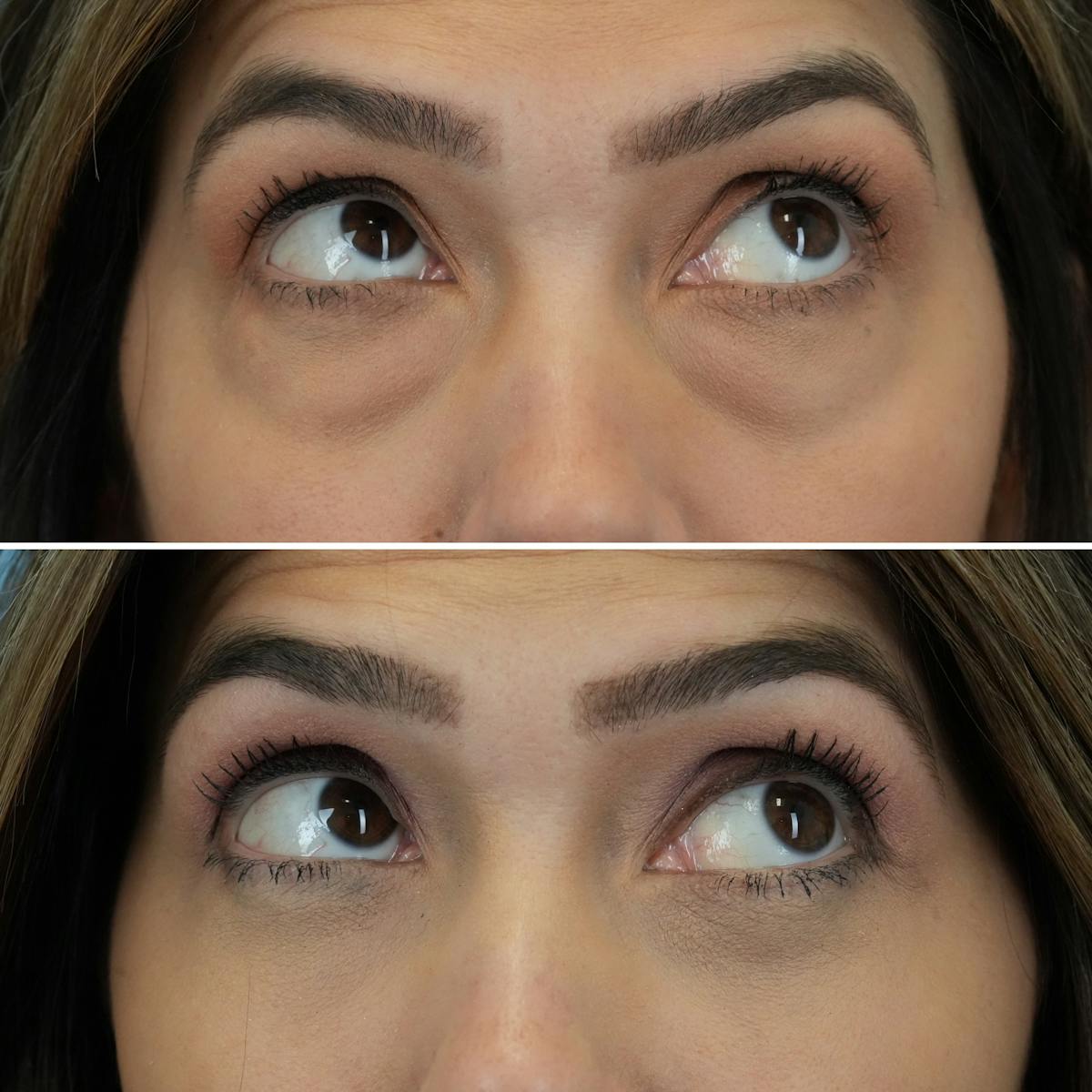 Blepharoplasty Before & After Gallery - Patient 841823 - Image 5