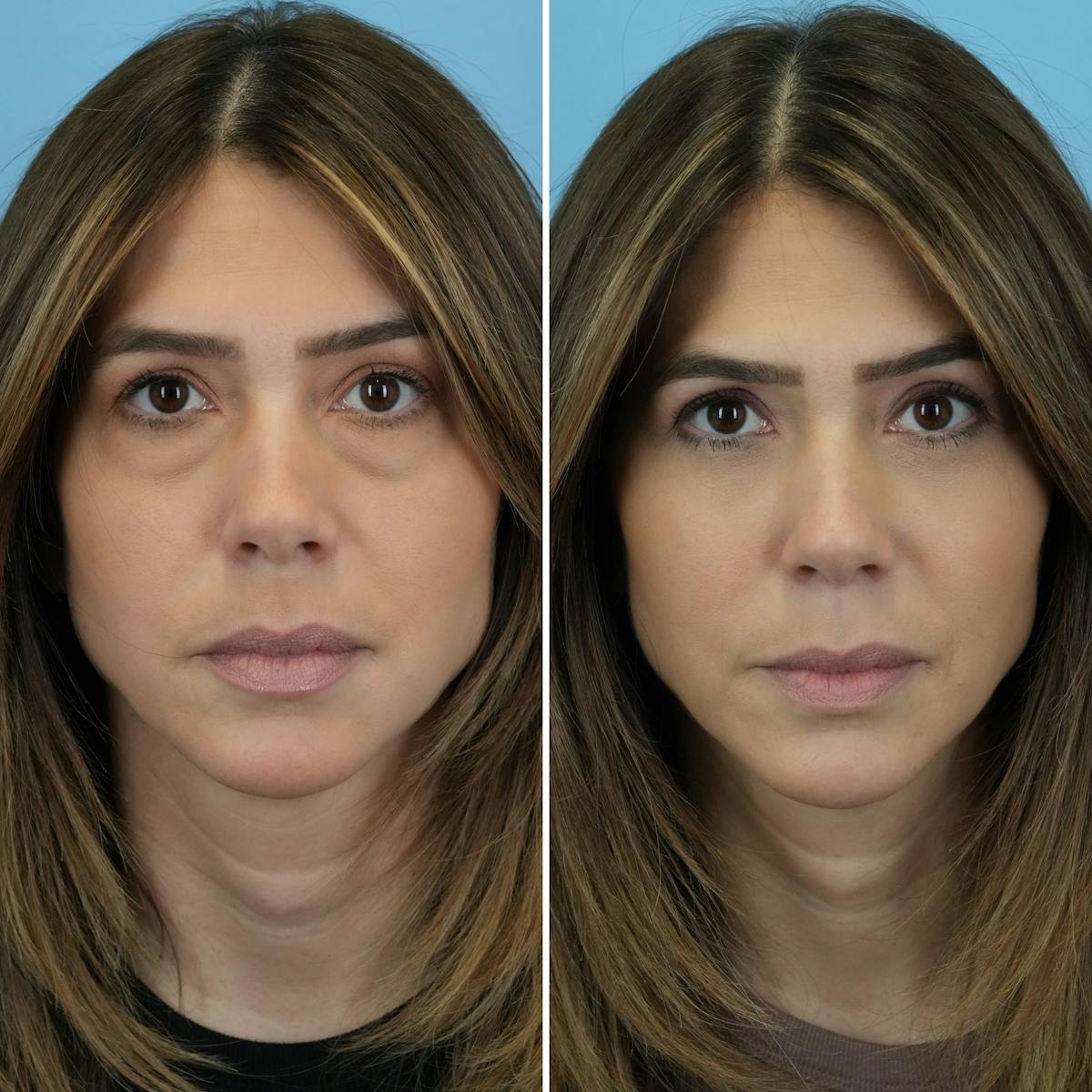 Blepharoplasty Before & After Gallery - Patient 841823 - Image 6